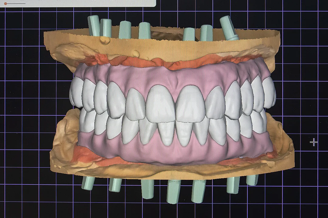 Digital konstruierte Full-Arch-Restauration in der CAD-Software